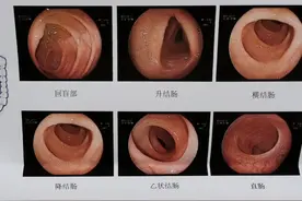 做肠镜有多痛苦图片