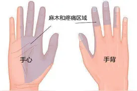 手腕疼，到底是腱鞘炎还是腕管综合征？医生教你分辨图片
