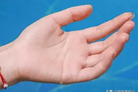天生的“水手”，其实是手汗症，那有哪些治疗方法呢？图片