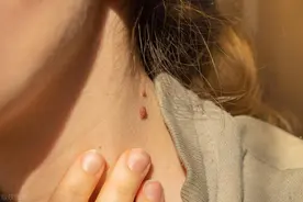 手上、脸上的“肉疙瘩”哪些是HPV导致的？6种常见疣的区分和治疗图片