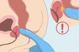 如何进行前列腺按摩？图片