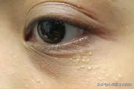 脸上有“脂肪粒”怎么办图片