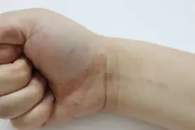皮肤瘙痒剧烈，起小水疱，这可能是湿疹！掌握这些方法，远离湿疹图片