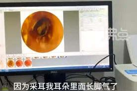 男子称采耳后耳朵里长了“脚气”，当事人：耳朵里长了一层白毛，还有一些溃烂，比较难治疗图片
