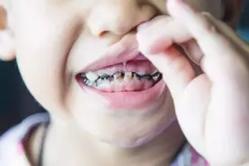 孩子蛀牙了需要补牙吗？拖延真的不是好办法图片