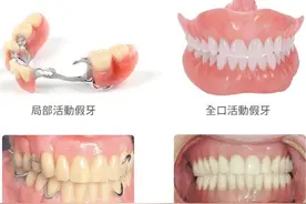 牙齿掉了，活动义齿、固定义齿、种植义齿该怎么选择？图片