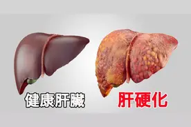 肝若有病，“屁先知”！一天放多少个屁才正常？专家说出答案图片
