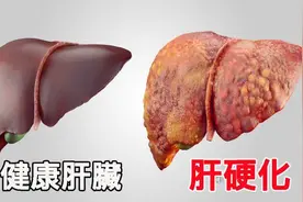 肝若有病，“屁先知”！一天放多少个屁才正常？专家说出答案图片