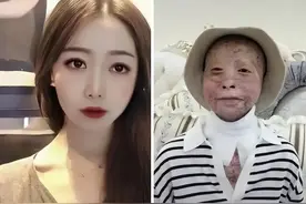 “折翼女孩”乔燕：被大火烧伤，经历13次手术，直言不需要同情！图片