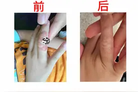 特应性皮炎，别再傻傻等自愈了图片