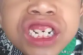 长治市第二人民医院：孩子新换的牙好丑！需要立刻做矫正吗？图片