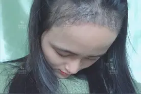 植发效果只能维持三年，这是真的吗？图片