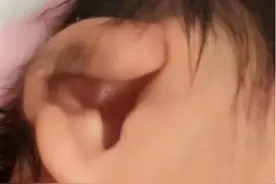 耳朵卷曲，原来她叫“杯状耳”图片