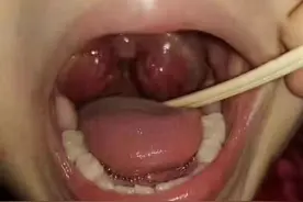医案：怎样治愈险被割掉的扁桃体肿大，秘诀在这里！图片