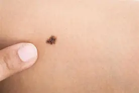 好声音张恒远因黑色素瘤去世，黑色素瘤到底长什么样？该如何治疗图片