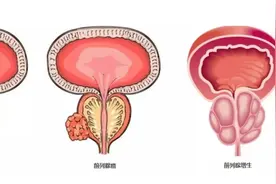 关注男性健康的隐秘“杀手”-前列腺癌图片
