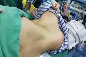 “可视化”麻醉护航 脊柱侧弯产妇顺利产下7斤健康男婴图片
