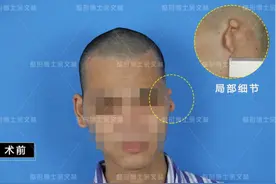「案例分析」成年小耳畸形患者做耳再造，效果很赞图片