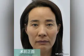 年龄增大，面部呈现“空”“松”“垮”怎么办？医生说出解决真相图片