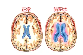 先天性脑积水，你了解吗？为患者和家属加油！图片