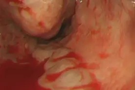 一直打嗝是胃的问题吗？图片