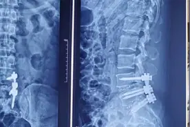 腰椎术后到底需要卧床休息几天？图片
