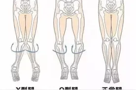 女生的腿合不拢意味着什么？（正经科普）图片