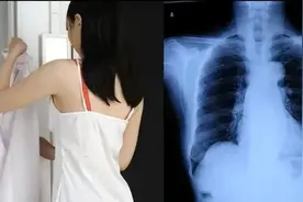 拍胸片时，医生一再要求脱光衣服，医生的流程是正常操作吗？图片