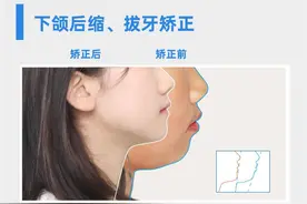 嘴凸的人怎么才能让凸嘴不明显？图片