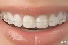 牙齿矫正牙套有很多种，选择哪种快捷又方便？图片