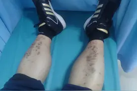 腿部出现这样的现象，可能是糖尿病且有并发症了图片