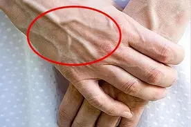 有些人手臂上“青筋暴起”，有些人却看不到青筋，哪种比较健康？图片
