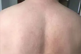 关于胆碱性荨麻疹的一些不一样的心得体会图片