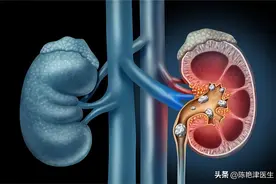 体检查出肾结石怎么办？医生：2个方法，或能让肾结石离开身体图片