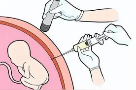 羊水穿刺很可怕吗？真相是来了图片