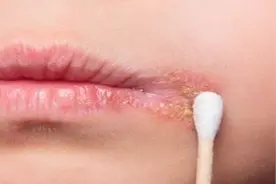 如果你不发生性行为，你仍然会感染性传播疾病图片