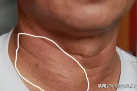 一个神奇的中成药，消肿散结、行气解毒、活血化瘀，专调各种结节图片