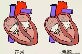 心房颤动临床症状及其预后图片