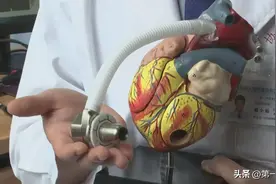 不开胸也能移植心脏？全球最小人工心脏成功植入，仅核桃大小图片