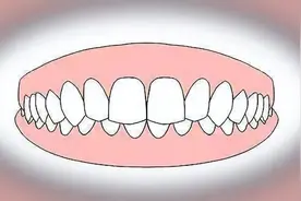 牙齿深覆合是什么？有什么危害吗？图片