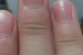 指甲出现凹点别大意，医生说可能与脱发有关。图片