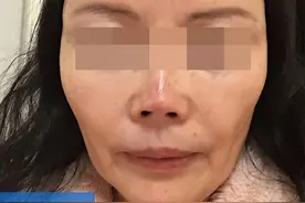 53岁把拉皮手术做了，6个月后，总结了4个惨痛教训图片
