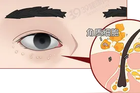 眼睛上若有1种表现，猝死风险可能大增！需要警惕严重高血脂图片