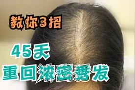 头发一梳掉一把？过来人教你3招！在家45天重回浓密秀发！！图片