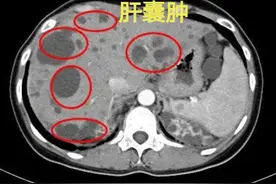 体检发现肝囊肿、肾囊肿严重吗？医生：这3个地方有囊肿要警惕图片