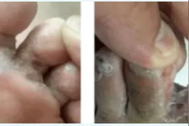 脚气类型图片