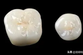 4大补牙材料大揭秘，让你少折腾少受罪图片
