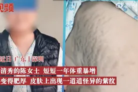 广东一女子突然体重暴增、变丑，随后查出脑瘤图片