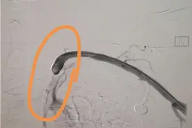我手上的脉搏哪去了？图片