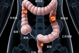 大肠长息肉了该怎么办？2类息肉处理方式不同，癌变的可能性高吗图片